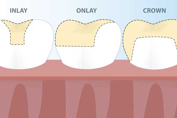 Inlays und Onlays